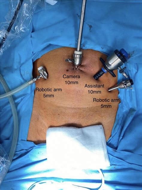 radical prostatectomy for men